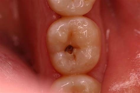 caries inicial-1